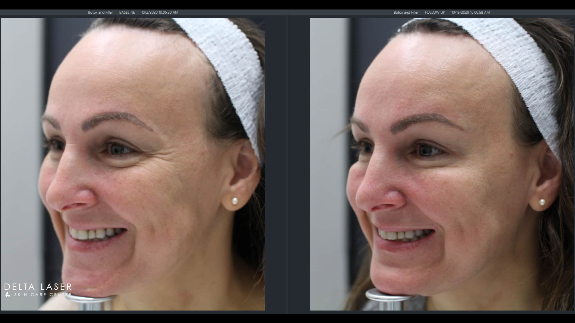 before and after botox face-1