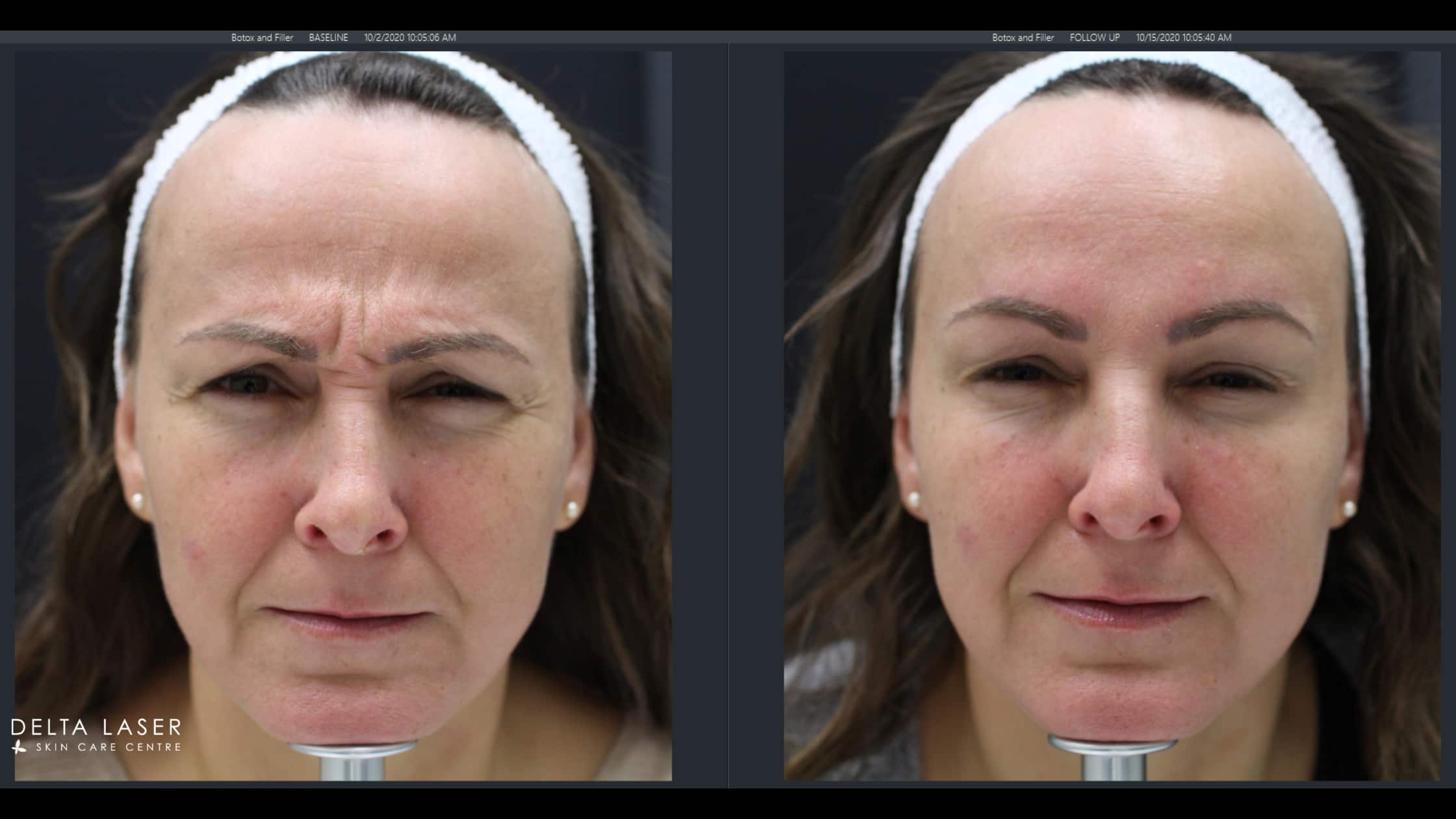 before and after botox face-2