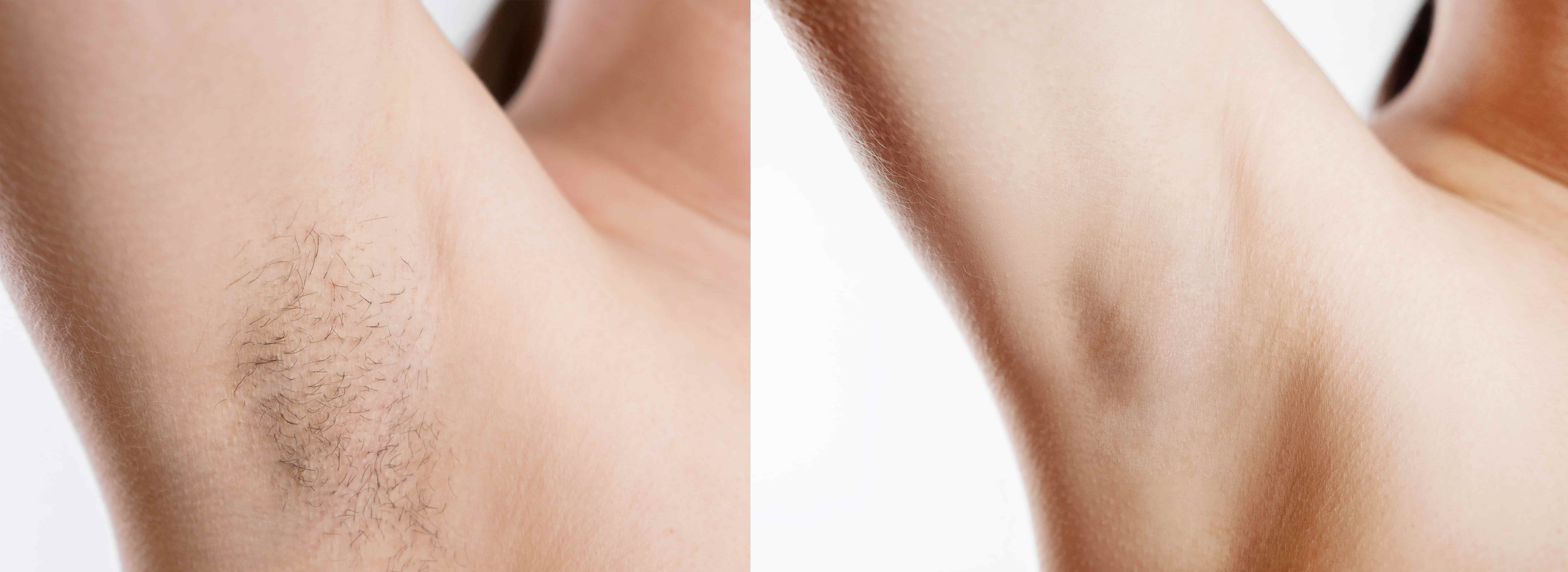 laser hair removal before and after delta bc