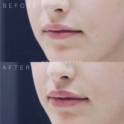 lip filler before and after-2