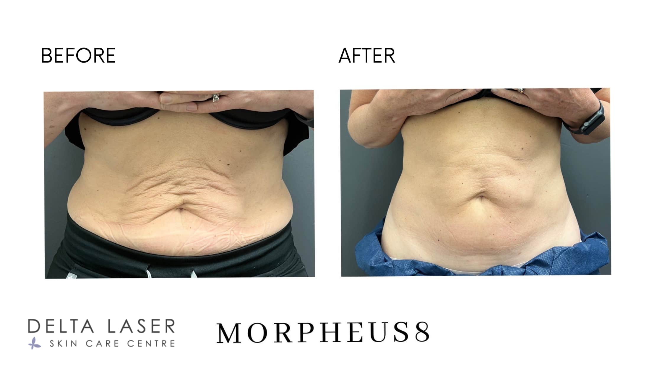 morpheus8 body before and after